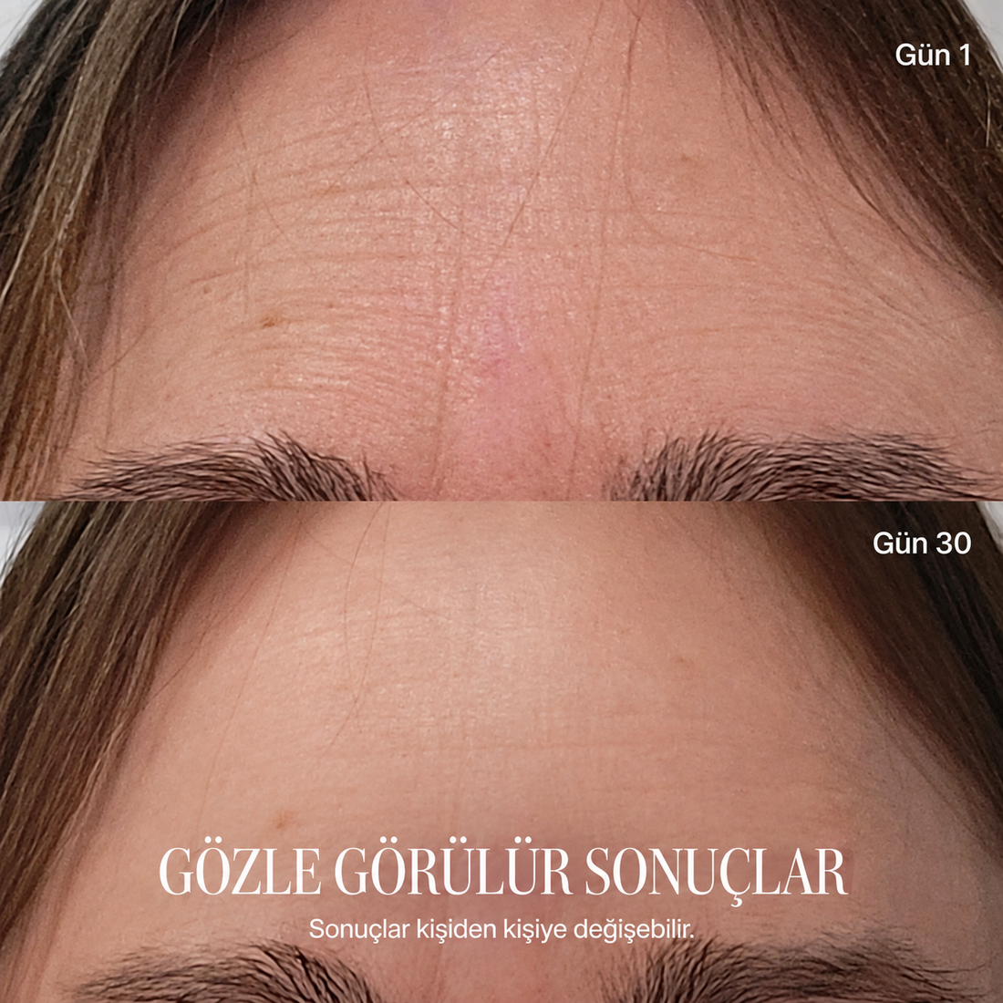 Siloura düzenli kullanım öncesi ve sonrası, sonuçlar kişiden kişiye değişebilir
